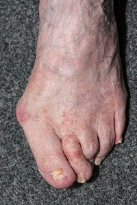 What Causes Bunions to Develop?