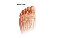 Causes and Nature of Morton's Neuroma