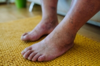 What Does Diabetic Limb Salvage Mean?